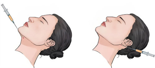 双下巴注射