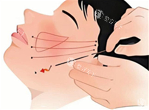 脸部拉皮卡通图