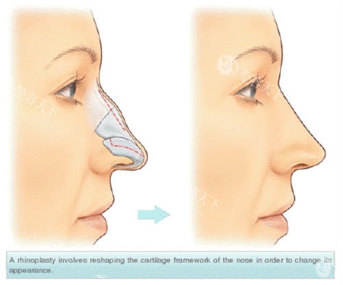 隆鼻手术假体隆鼻