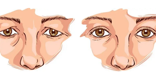 双眼皮修复前后