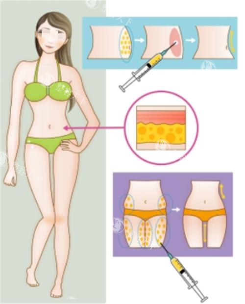 武汉陈远海医生靠谱吗？十年经验+吸脂减肥技术解析
