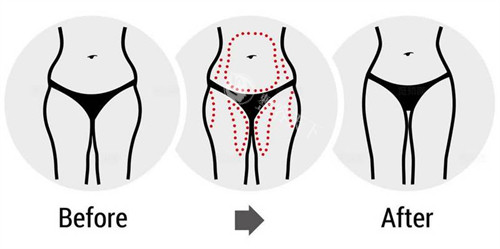 腰腹大腿吸脂前后对比图