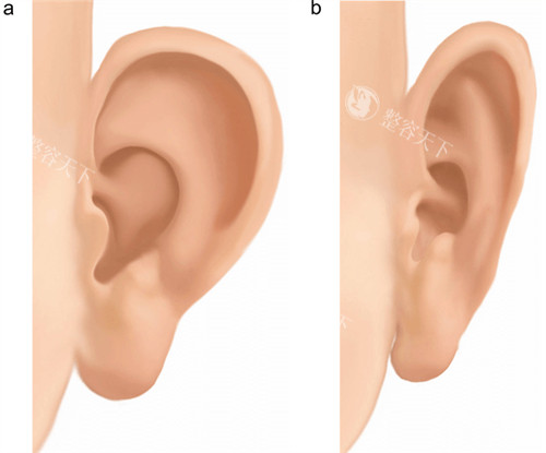 改善耳朵形状