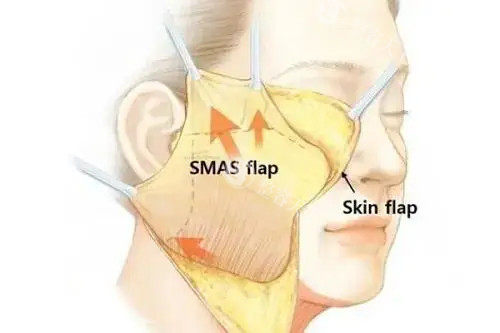 面部拉皮卡通示意图