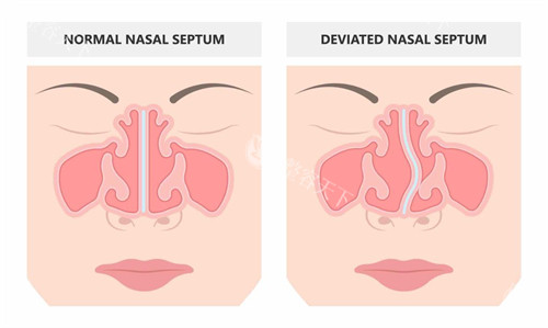 鼻修复手术前后对比