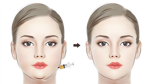 面部注射<span class='highlight'>溶脂针</span>前后对比动画图