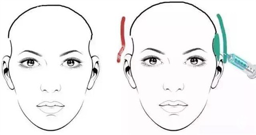 太阳穴凹陷玻尿酸注射对比动画图