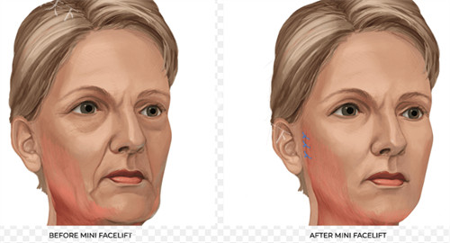 何金生注射抗衰靠谱吗？乔雅登指定医师_面部精塑人气预约中！