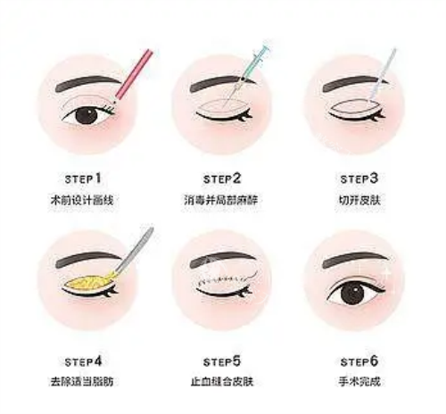全切双眼皮流程图示