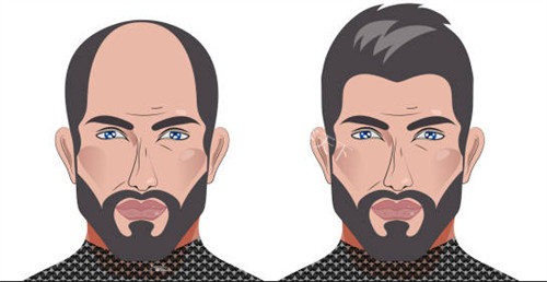 上海植发哪家好？韩卓整形10800起_张强院长眼鼻+植发+埋线提升全覆盖！