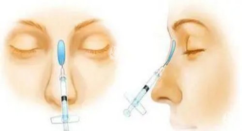 玻尿酸注射隆鼻示意图