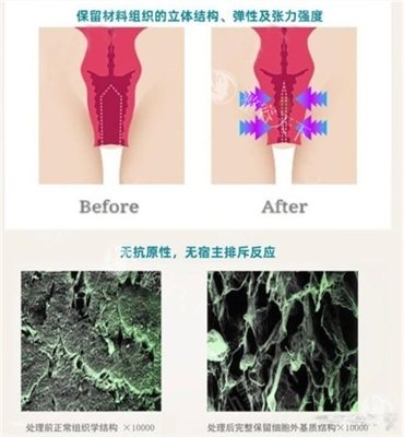 3d生物束带紧缩术前后对比漫画