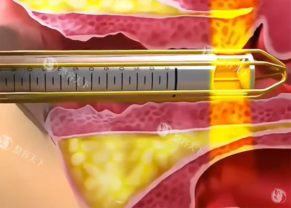 紧缩针推药示意图