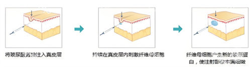 卿特美玻尿酸大揭秘！多型号价格曝光，塑形抗衰结果惊艳，速来了解！