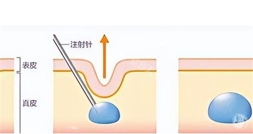 玻尿酸注射皮肤前后对比