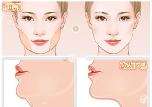 重庆腰腹抽脂价格大比拼！罗海军、唐国强等医生技术优势全揭秘