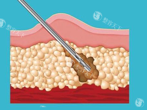 吸脂针图片