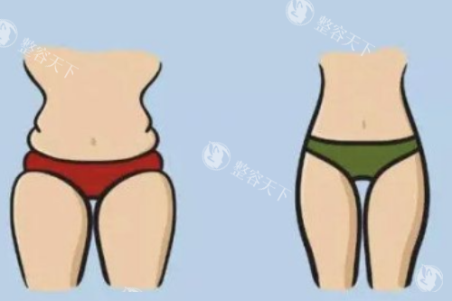 腿部吸脂对比图