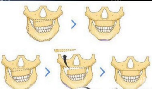 成都罗恩面部轮廓整形体验分享!自然不脸垮,闺蜜都说我素颜像换脸