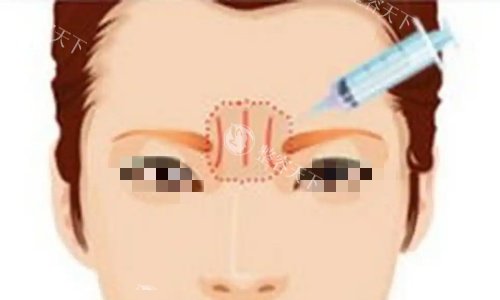 川字纹纠结打玻尿酸还是改善皱纹?动态纹静态纹区别大了,选对省下冤枉钱