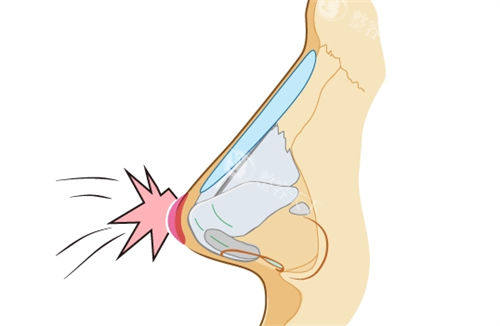 隆鼻假体鼻背动画展示图