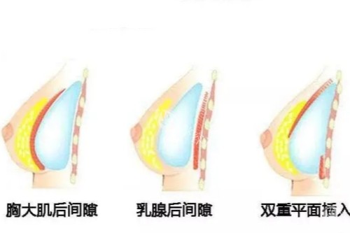 假体隆胸植入位置示意图