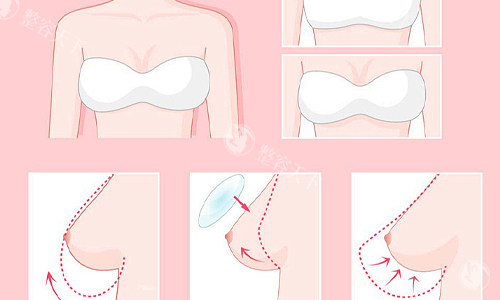 隆胸的流程展示