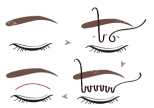 埋线双眼皮过程图示