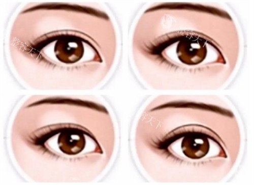 不同双眼皮形态参考图