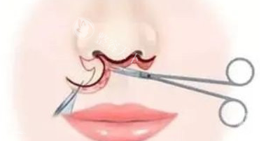 郑州池凯口周整形咋样？20年经验+CO₂激光无痕术，人中缩短/微笑唇自然不僵硬，面诊不忽悠很实在