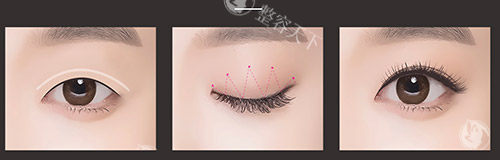 埋线双眼皮过程示意图