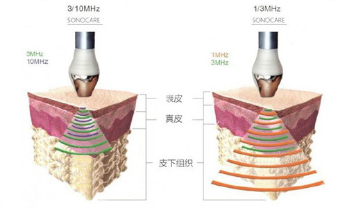 10MHz超声波黑科技：LDM水滴提升值不值得做？原理+疗程攻略