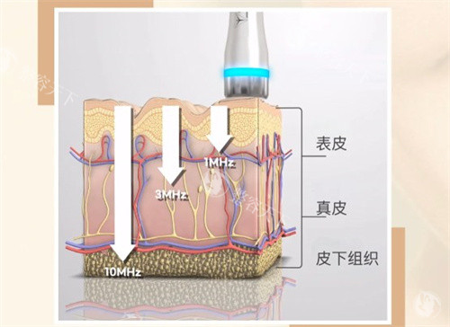 LDM水滴提升是什么