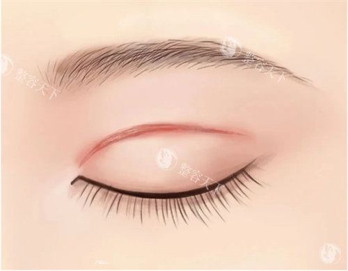 双眼皮肉条疤痕图