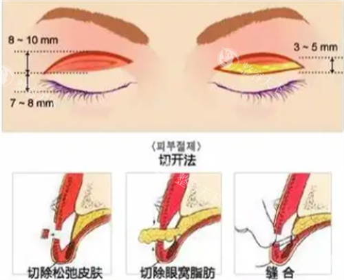 榆林美立方双眼皮手术靠谱吗？医生技术+价格明细全公开！
