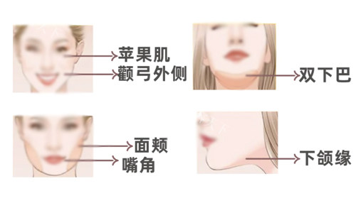 面部溶脂适用人群