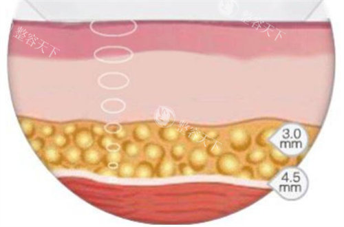 超声波溶脂演示动画图