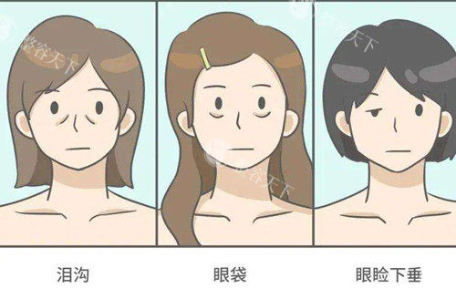 眼周衰老问题卡通示意图