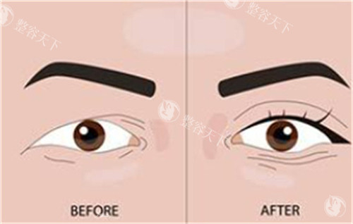双眼皮手术前后对比