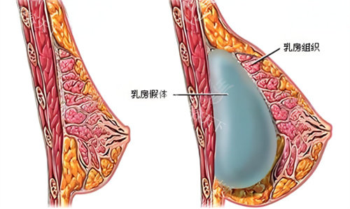 假体隆胸术原理图