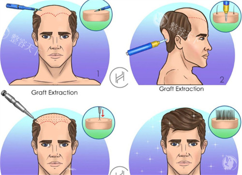 脂溢性脱发植发前后对比图