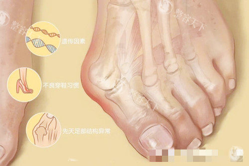 上海虹桥医院足足外翻大脚骨手术做的怎么样?上海虹桥医院治疗拇外翻成效好口碑好,附大脚骨价格表!