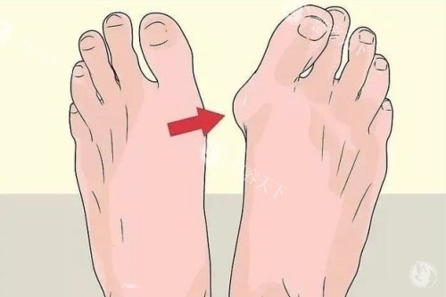 大脚骨整形前后对比图