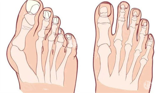 大脚骨的脚和正常对比