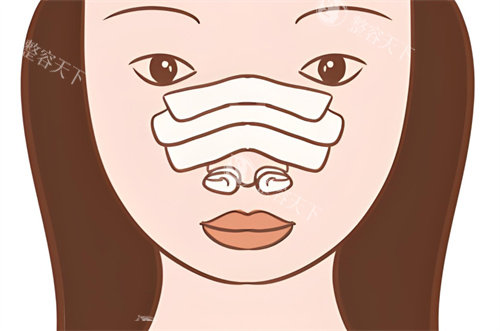 隆鼻修复术后图