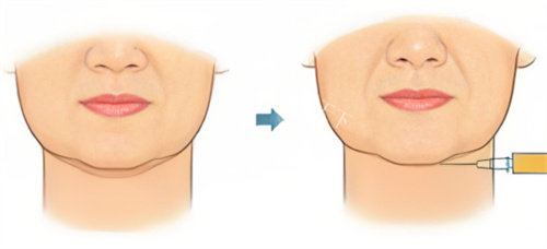 双下巴注射示图