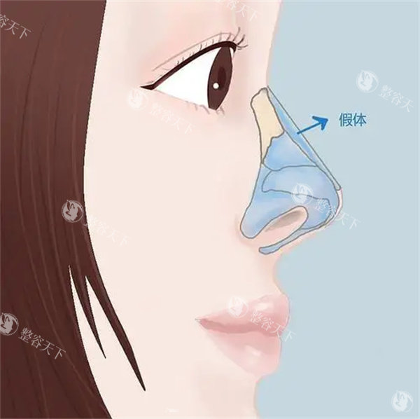 假体隆鼻整形手术