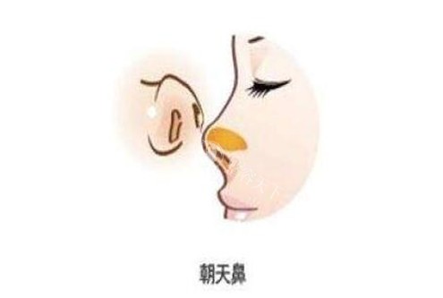 朝天鼻整形手术