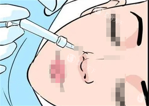 玻尿酸注射鼻子动画展示