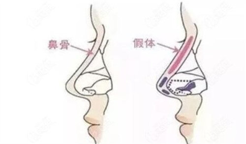 隆鼻手术示意图